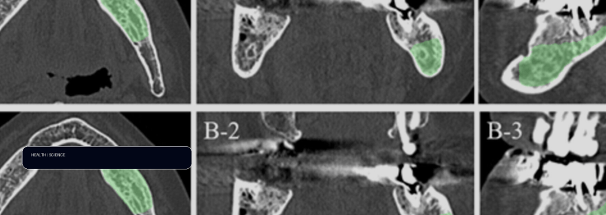Pretreatment CT scans may contain clues about the risk of medication-related osteonecrosis illustration